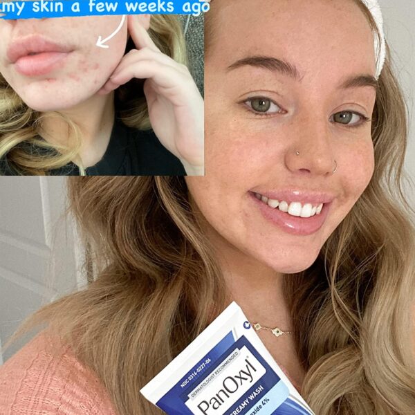 Panoxyl Acne Creamy Wash 4% Benzoyl Peroxide 170 g – Image 3